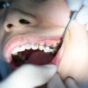 Brackets estéticos Granada