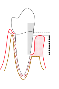 Periodontitis